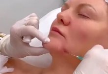 "Козьи подбородки" — новый бьюти-тренд набирает популярность