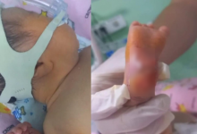 Врачи сожгли кожу на пятке новорожденного в роддоме Кызылорды