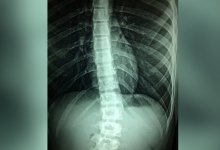 Революционное открытие в лечении паралича сделали ученые из Японии