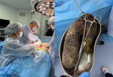 Алматинские хирурги удалили 1,5 кг волос из желудка пациентки