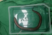 Хирурги обнаружили живого угря в животе мужчины