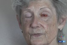 Врачам удалось вернуть зрение женщине, вставив ей зуб в глаз