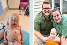 Мальчик с мозговой грыжей на лбу выжил и развивается вопреки прогнозам врачей