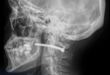 Гвоздь возле позвоночника: петропавловцу чудом удалось выжить