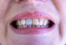 Виниры наполовину: жительница ВКО осталась без нижнего ряда "зубов"
