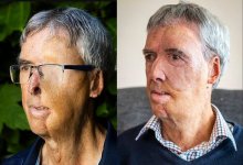 Потерявшему половину лица в ДТП мужчине напечатали протез на 3D-принтере