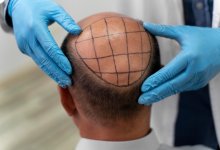 36-летний мужчина умер после пересадки волос