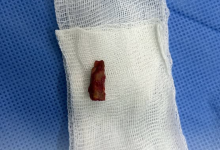 Мальчик пять лет прожил с веткой под кожей в Павлодаре