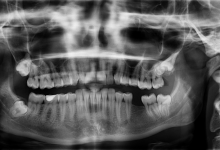 Стоматологи обнаружили пулю в челюсти пациентки из Караганды
