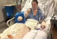 Женщина лишилась ноги после нападения питомца