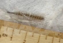 Забыли "ершик" в матке: гинеколог едва не погубила пациентку в России