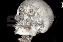 Собрали как пазл: мужчине раздробило лицо после падения со снегохода