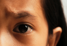 Прыщ на лбу довел россиянку до больницы