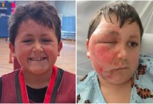 Ребенок получил ожоги лица из-за тренда в Tik-Tok (ВИДЕО)