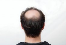 Лечить облысение за счет государства планируют в Южной Корее