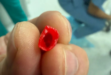 Врачи извлекли из бронхов ребенка колпачок от ручки в Актау