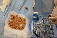 80 камней удалили из мочевого пузыря пациента в Туркестане