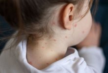 Заболеваемость корью растет в ЗКО