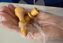 Две шахматные фигуры извлекли хирурги из прямой кишки мужчины