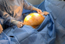 Алматинке удалили 25-килограммовую опухоль после приема БАДов