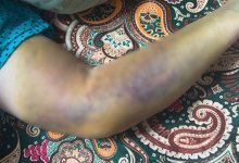 Скандал в больнице Актау: после капельницы рука женщины "перестала работать"