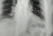 Бур провалился в бронхи пациента во время лечения зубов в России