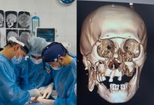 Уникальная 9-часовая операция вернула пациенту лицо и надежду в Алматинской области