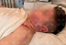 Ребенок лишился пальцев и получил перелом позвоночника на аттракционе в России