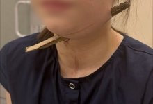 Ветка насквозь пробила шею девочки после прыжка с гаража в Ростове-на-Дону