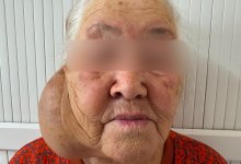 Огромную опухоль удалили хирурги с шеи жительницы Алматинской области