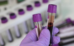 Слабость и сонливость не всегда говорят о дефиците железа - эксперт