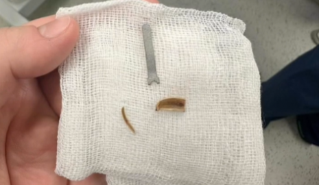 Железка месяцами скрывалась в легких ребенка из Мангистау