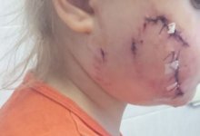 Собака покусала лицо 4-летней девочки в Караганде